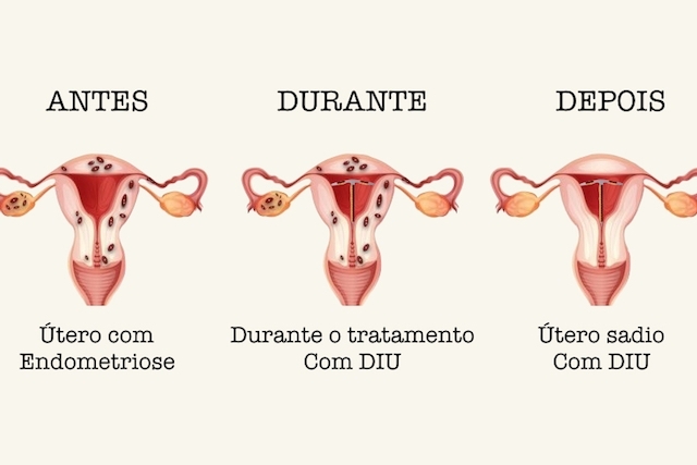 DIU trata a endometriose